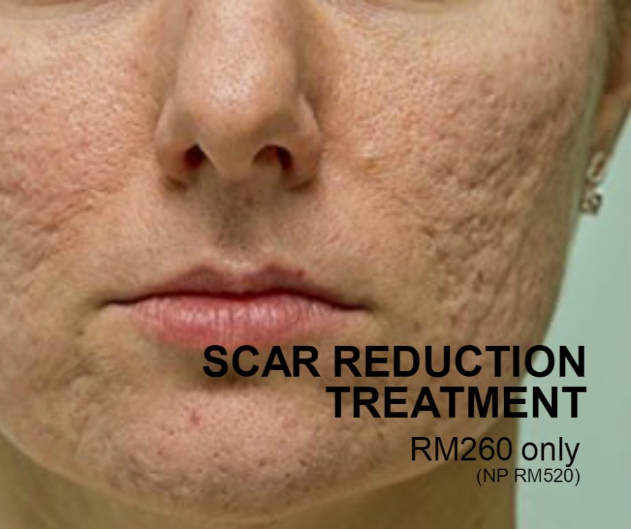 Scar Reduction Treatment