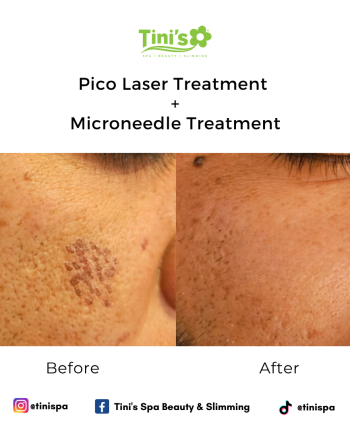 Rawatan Pico Laser - Pigmentasi Kulit Muka dan Jeragat | Tini's Spa