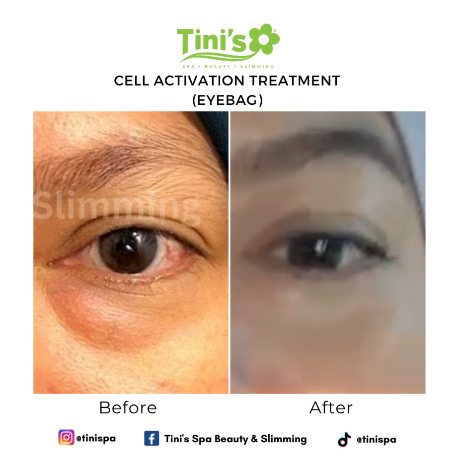 Eye Bag Treatment For Under-Eyes Dark Circles