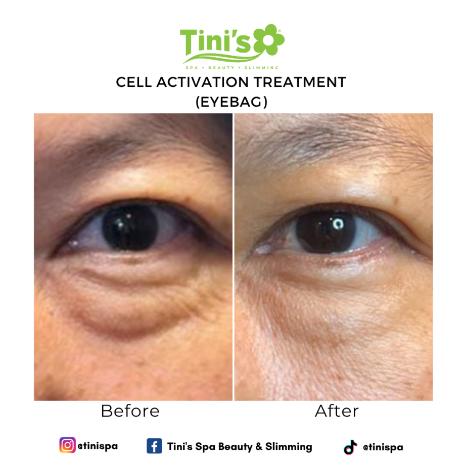 Eye Bag Treatment For Under-Eyes Dark Circles