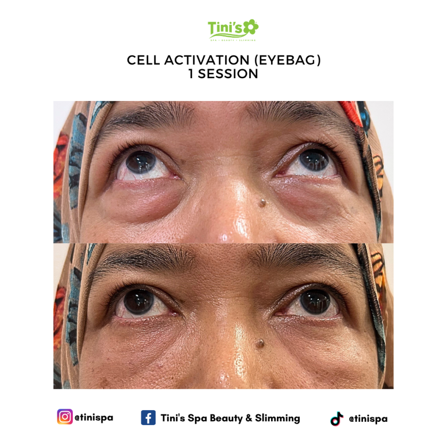Eye Bag Treatment For Under-Eyes Dark Circles
