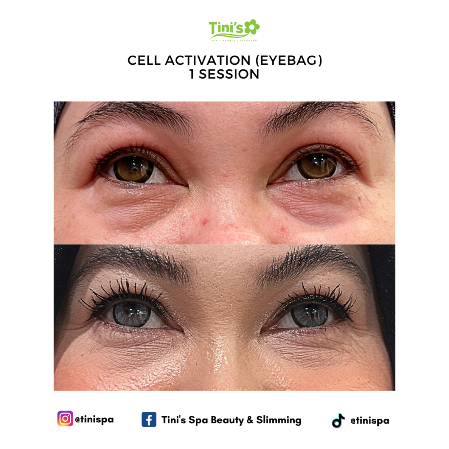 Eye Bag Treatment For Under-Eyes Dark Circles