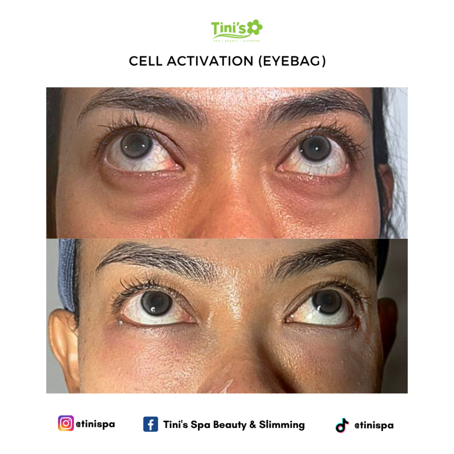 Eye Bag Treatment For Under-Eyes Dark Circles | Tini's Spa