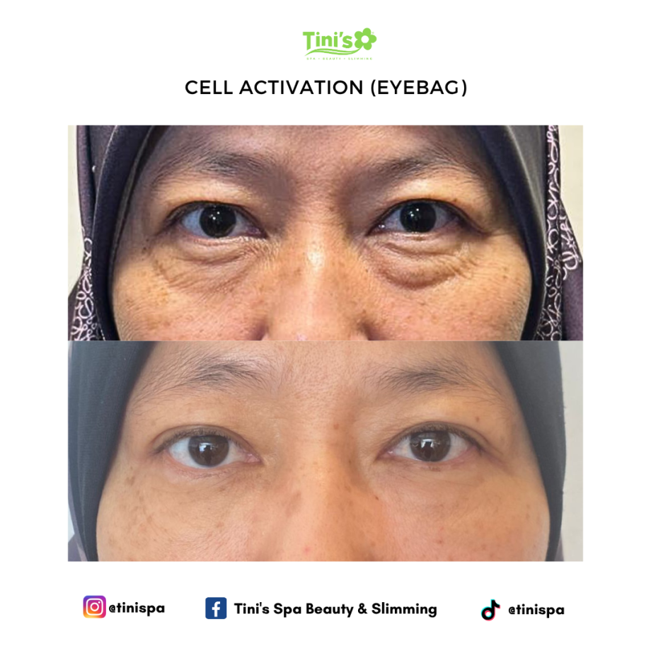 Eye Bag Treatment For Under-Eyes Dark Circles