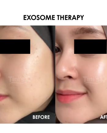 exosomefeedback@tinispa